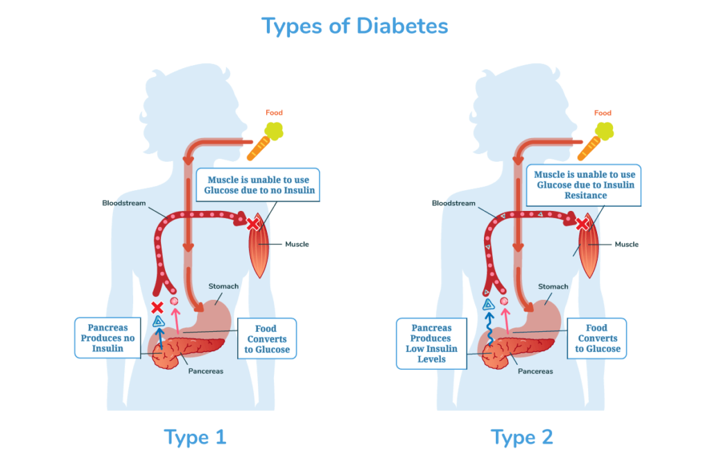 Diabetes Graphic