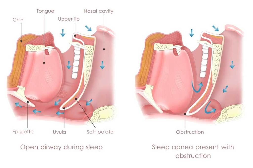 Sleep Apnea structure